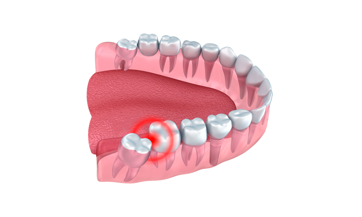 Зубы мудрости («восьмёрки») — самые дальние в челюсти