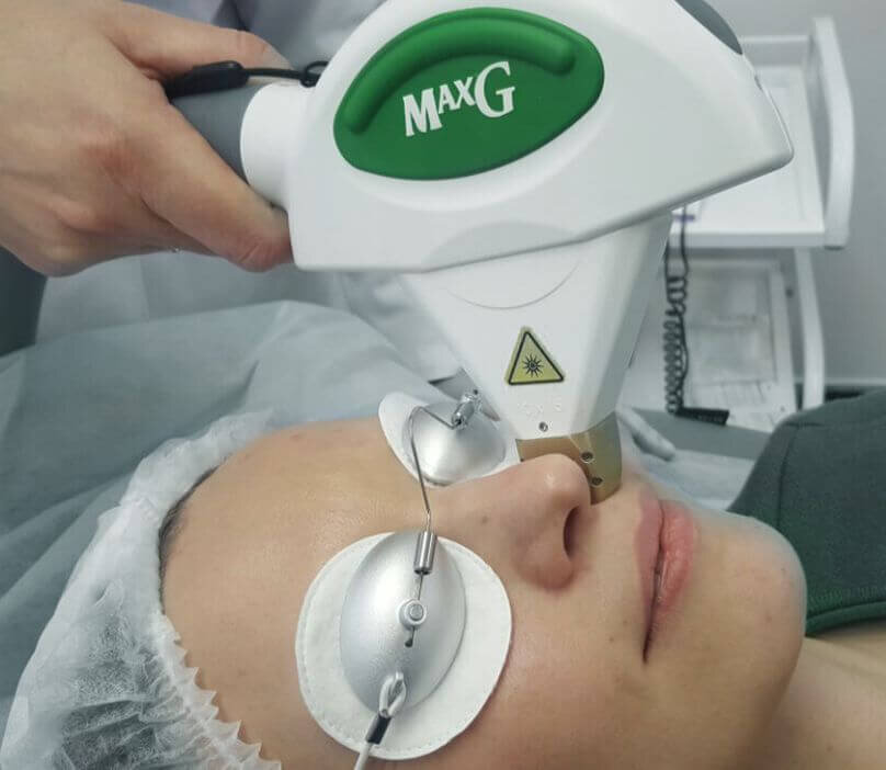 Лечение купероза лазером