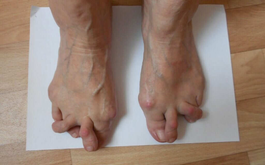 Ревматоидный артрит. Фото: https://newhospital.ru/