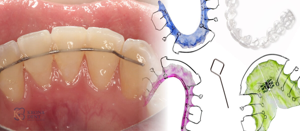 После брекетов зубы разъехались | Статьи