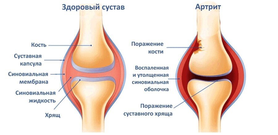 Скопление жидкости в коленном суставе причины