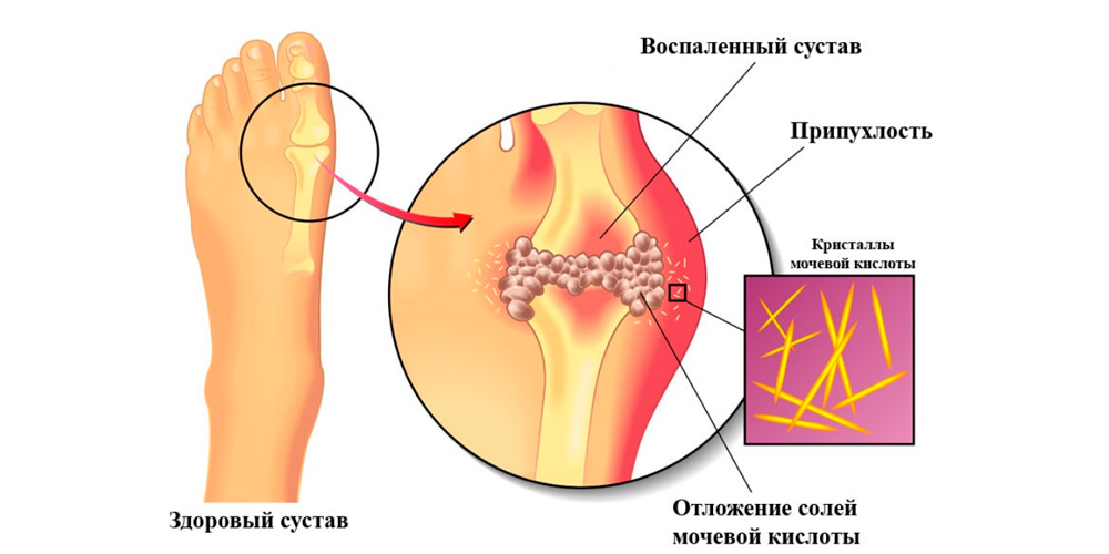 Подагра король
