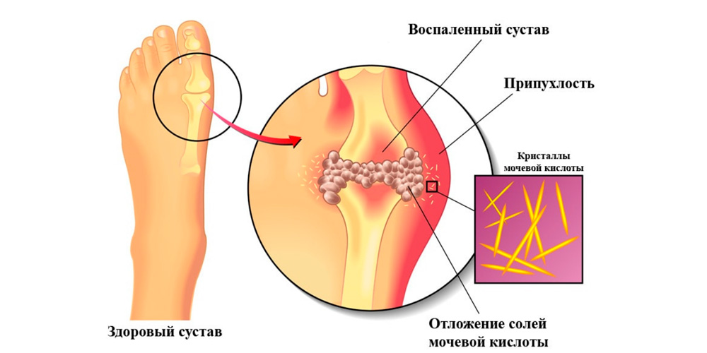 Одной из самых первых болезней, описанных в медицинской литературе, является подагра. Слово «подагра» в прямом переводе с древнегреческого означает «нога в капкане».-2