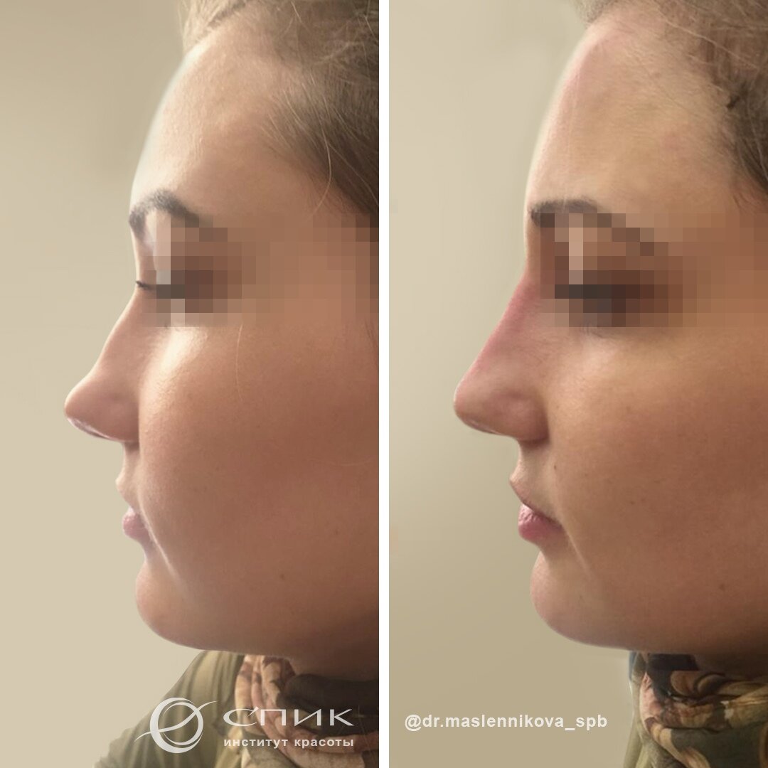 Результат работы врача-косметолога Елены Владимировны Масленниковой
