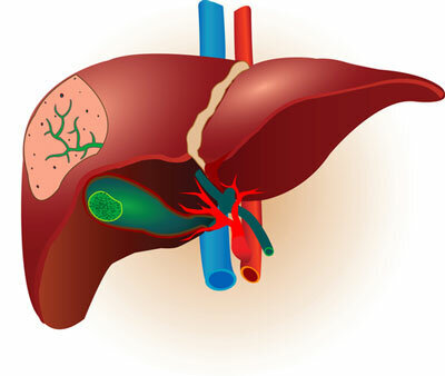 Рак желчевыводящих  путей считается очень серьезной и коварной патологией