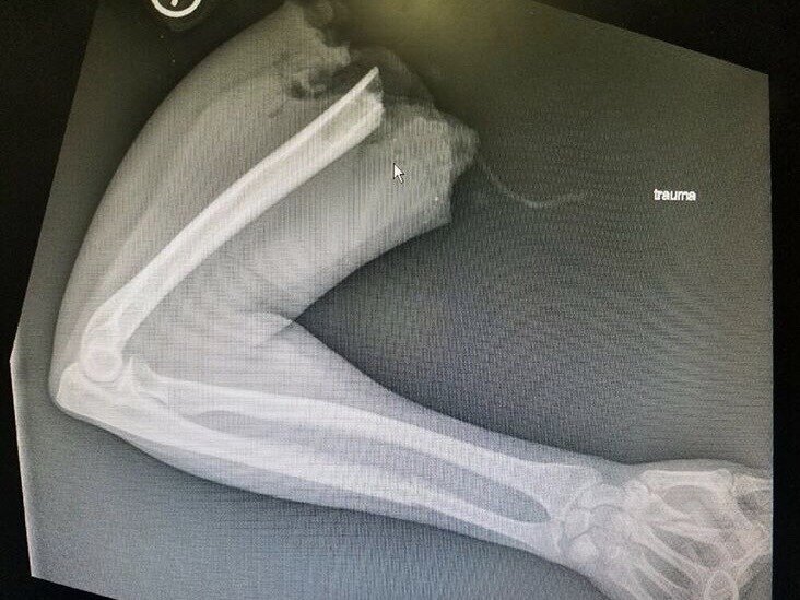 Авария с участием мотоциклистки, которой оторвало руку.