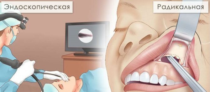 Спящий зубной гайморит, или мина замедленного действия!