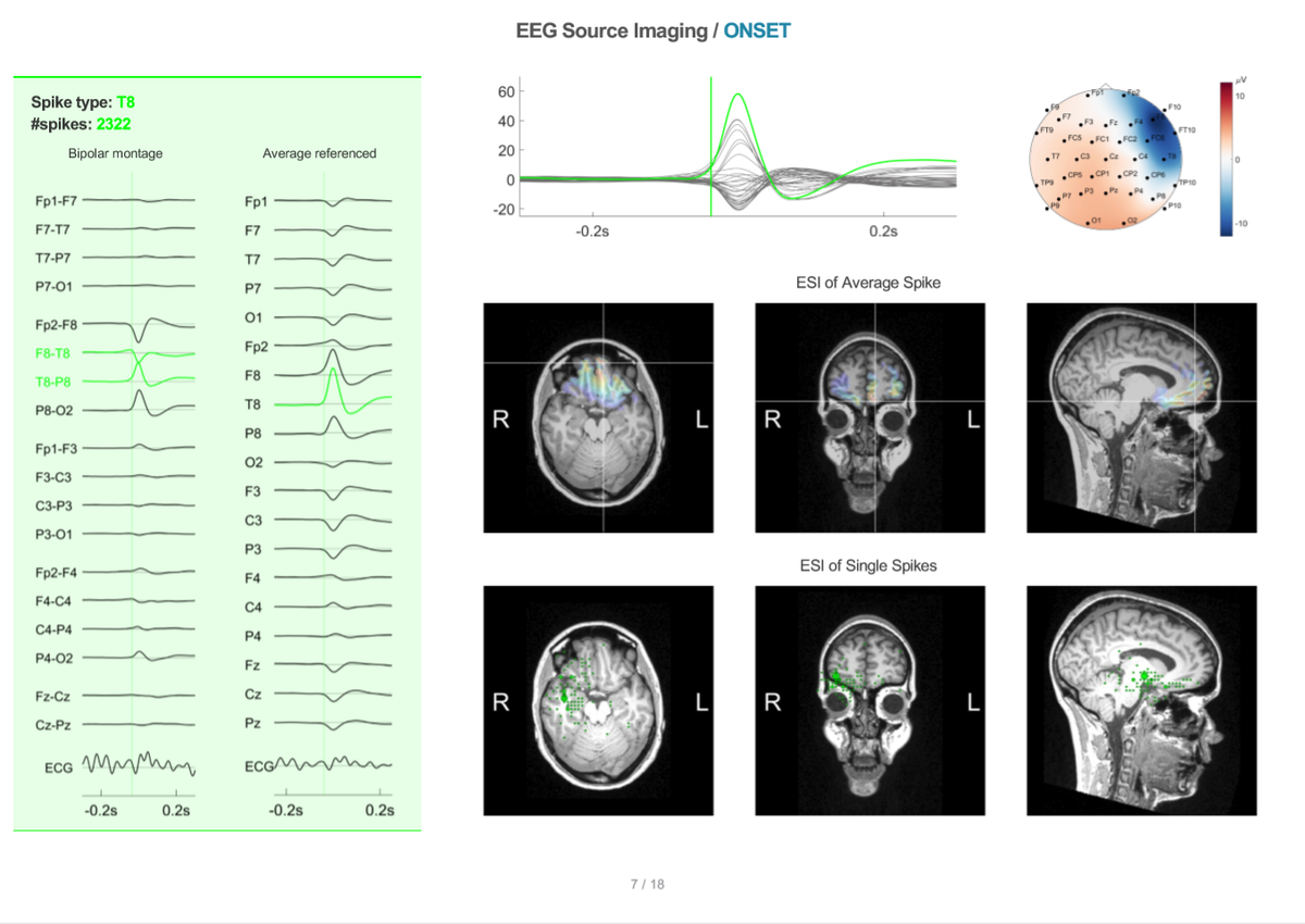 Делают ээг год. Электроэнцефалография головного мозга (ЭЭГ). ЭЭГ мониторинг с электродами. Визуальный анализ ЭЭГ. Схема прибора ЭЭГ.
