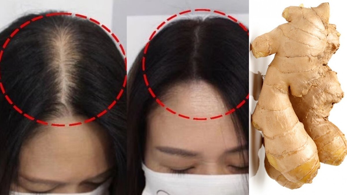 #лечениеволос #выпадениеволос #облысение #какотраститьволосы #уходзаволосами #уходзаволосами #дляроставолос #алопеция 