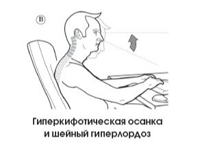 Гусиная шея у молодых людей. Почему она возникает и как убрать ...