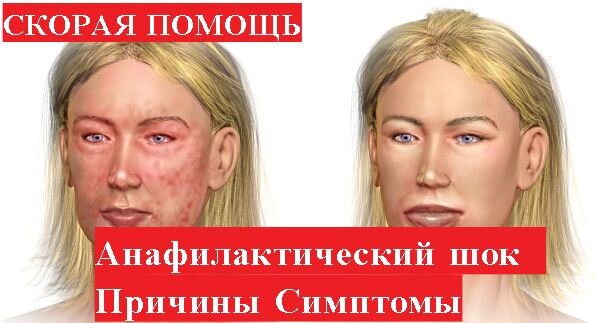 Внимание!Вся информация в видео только для ознакомительных целей!При возникновении каких либо симптомов вызывается скорая медицинская помощь! 