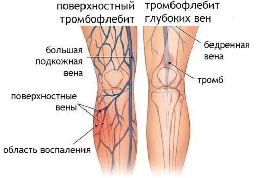 Виды тромбофлебита