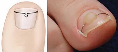 Потом, как ноготь зажил (все вышеописанные процедуры так же продолжали делать ЕЖЕДНЕВНО+после операции 5 дней пропили антибиотик), пошли к хорошему подологу и установили на оба ногтя титановую нить – эдакую скобочку по краям ногтя, которая не дает ему расти вбок. Стоит это удовольствие от полутора до трех тысяч рублей на ноготь. Выглядит примерно так: