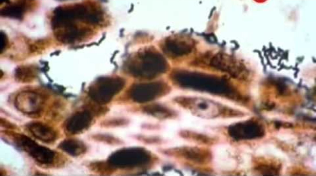 2. Helicobacter pylori