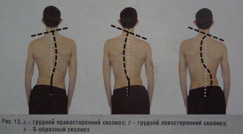 Искривление грудного отдела позвоночника: что делать?