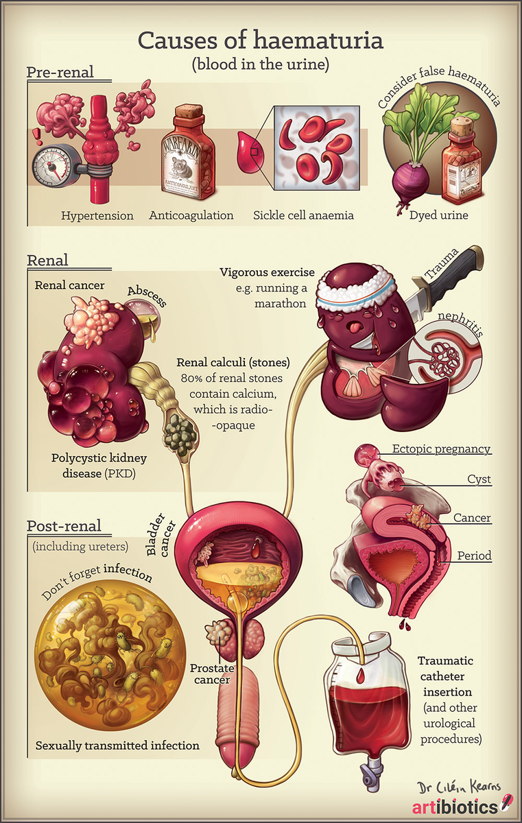 Кровь в моче - гематурия| Симптомы, осложнения, диагностика и лечение