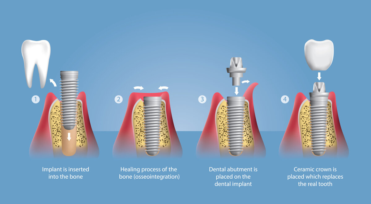 Этапы одномоментной имплантации зуба
