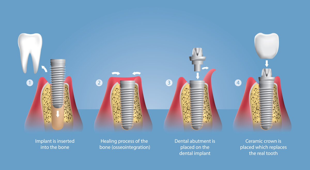 Имплантация зубов презентация