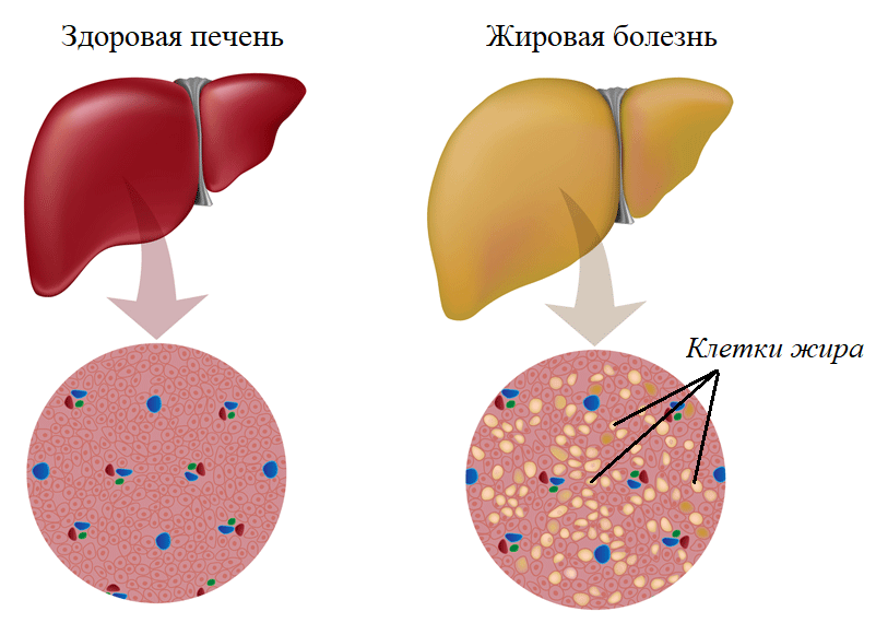 Увеличен сосудистый рисунок печени