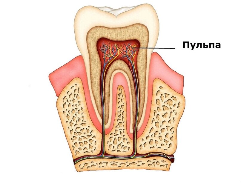 Удаление нерва зуба: показания, как удаляют, зуб после удаления
