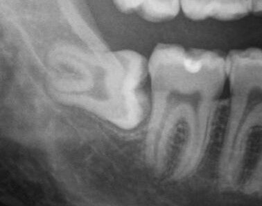 Горизонтальное положение зуба мудрости, одно из самых неприятных, потому что  у зуба нет ни одного процента на нормальное прорезывание, так еще для того, чтобы его удалить, порой приходится убирать всю вышележащую кость.