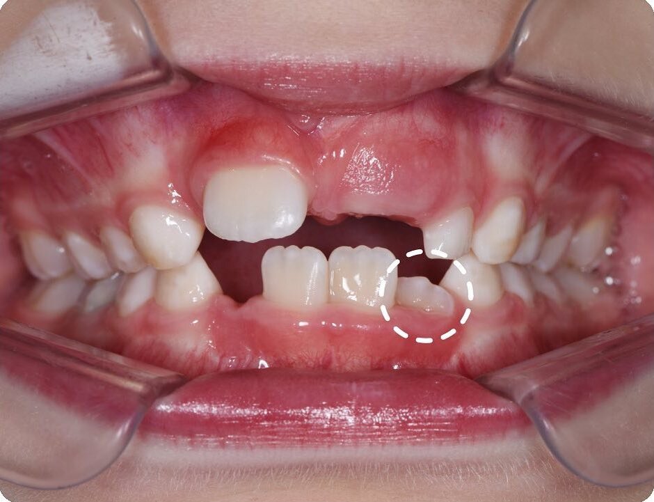 Из-за дефицита места зуб занял неправильное положение