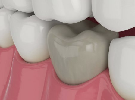 Отбеливание мертвого зуба: особенности и способы