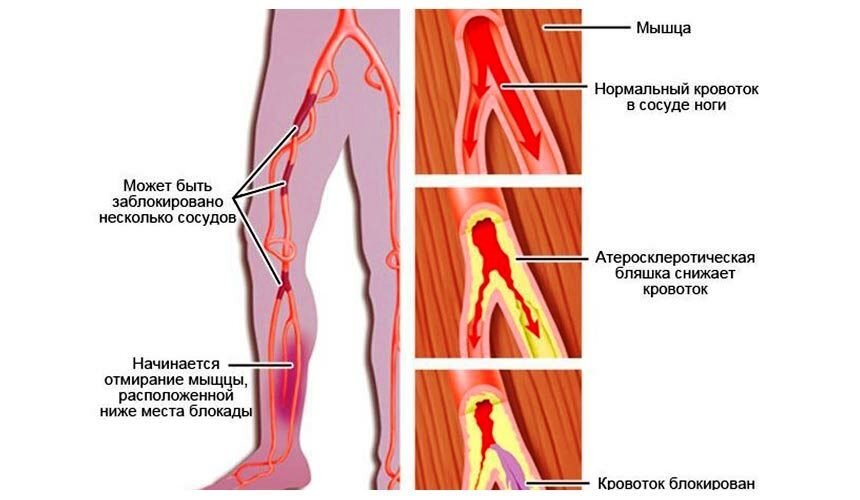 Атеросклероз сосудов нижних конечностей — что это, симптомы и лечение