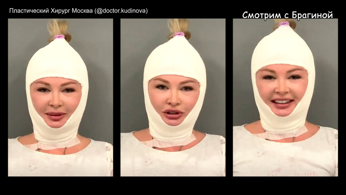 Даша пынзарь до и после пластики фото Дарья Пынзарь сделала круговую подтяжку за 450 тыс. руб. Смотрим ДОМ-2 с Брагино