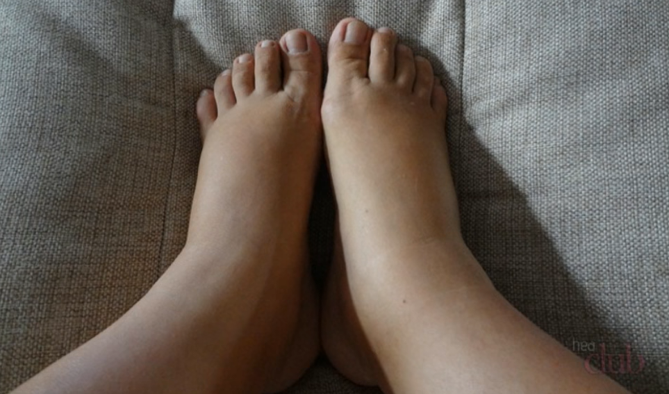 Фото опухших ног