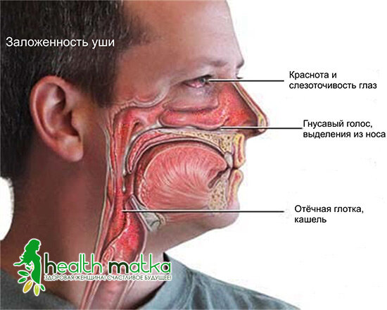 Основные симптомы аллергического ринита