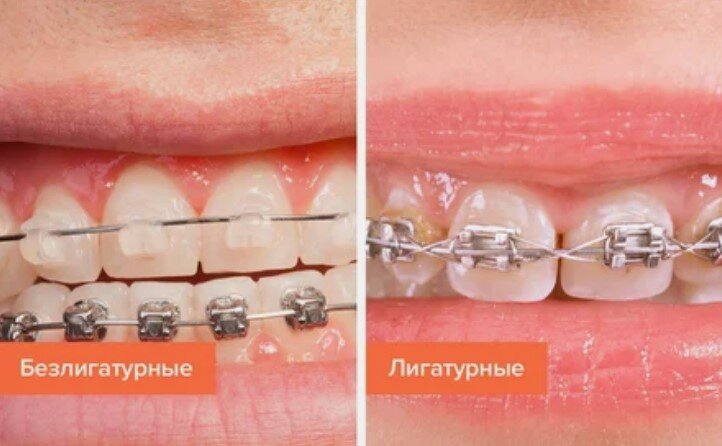 Брекеты с лигатурами или без: разбираем, чем они отличаются и какие из них – лучший вариант