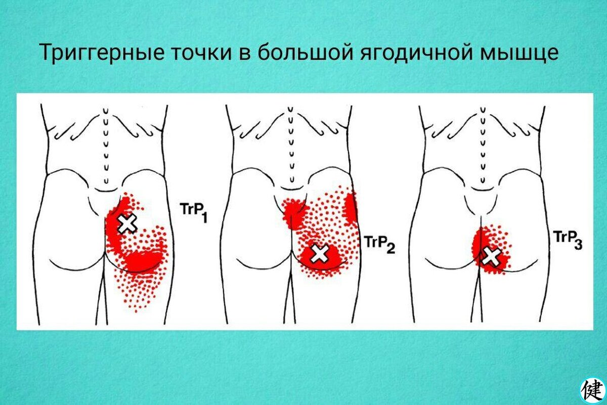 Триггерные точки в средней ягодичной мышце | Здоровье с нами | Дзен