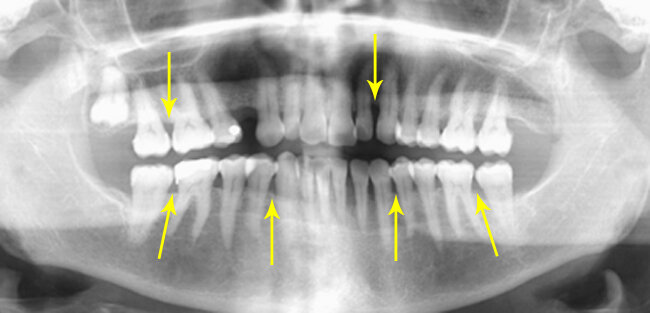 Рентгеновский снимок ОПТГ при пародонтозе. Жёлтыми указателями указана убыль костной ткани.