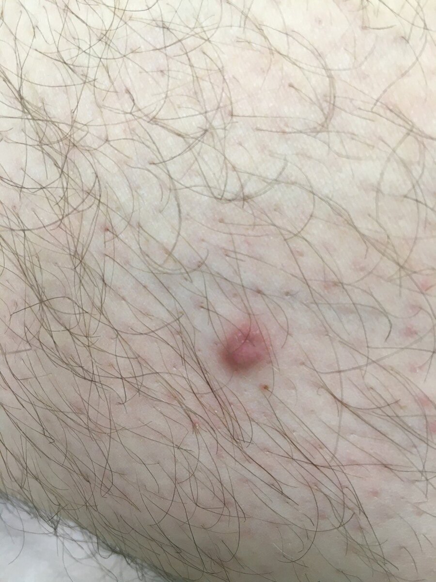 Первая - на коже голени