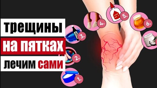 Трещины на пятках – что они скрывают и что делать в домашних условиях