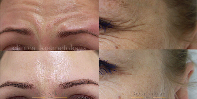 Фото До и После ботулинотерапии