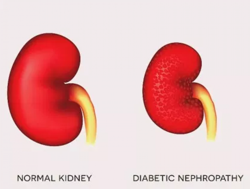 Диабетическая нефропатия картинки