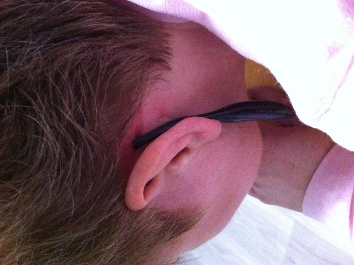 пиявки на сосцевидных отростках. Фото личное