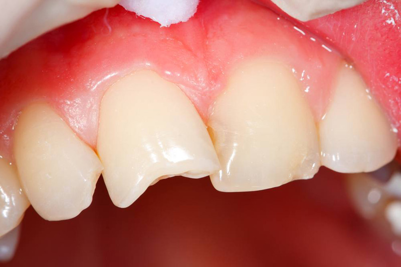 Можно ли восстановить зуб, если он откололся | Стоматология Мята