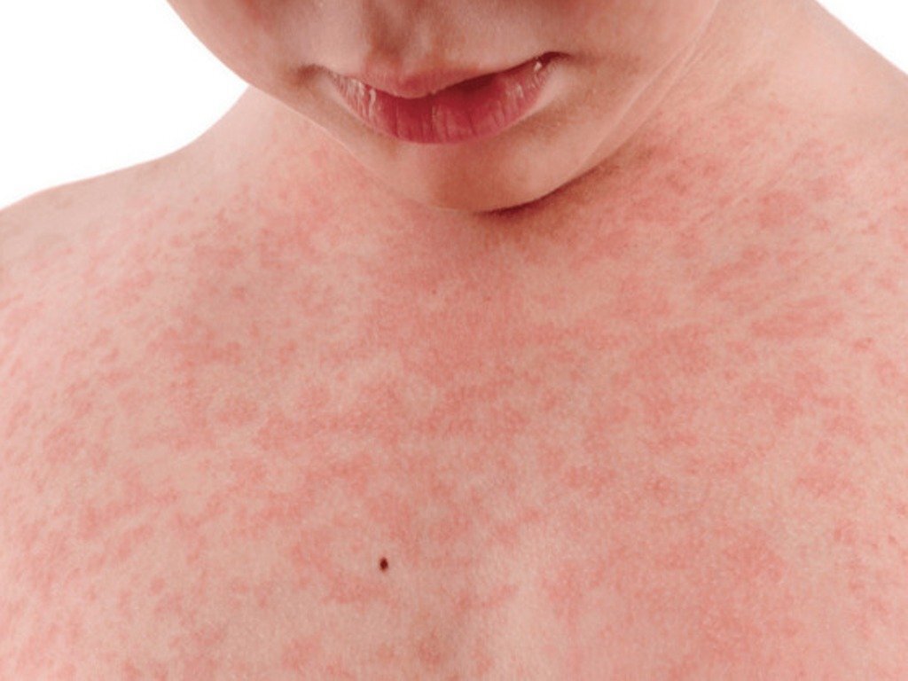 Экзантема (из открытого источника)