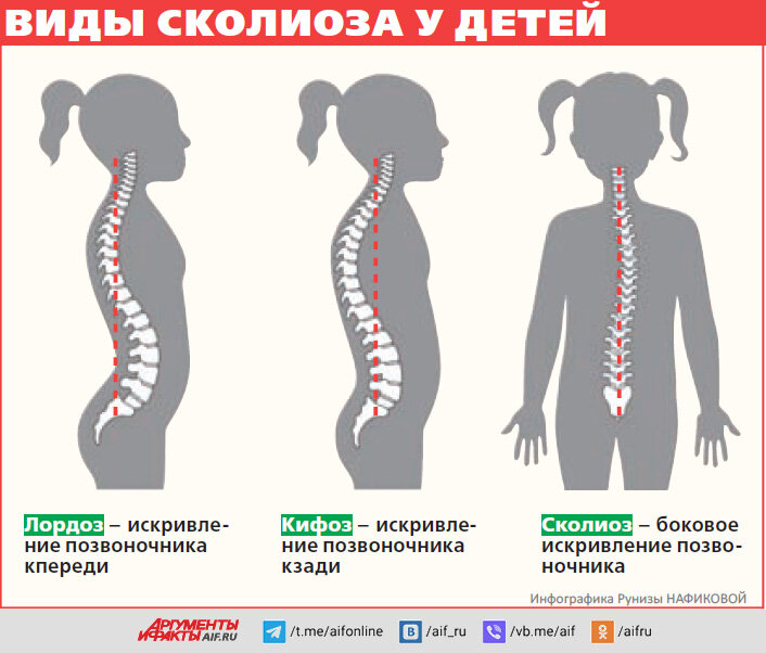 Как уберечь школьника от сколиоза? Советы реабилитолога Оксани Слинько