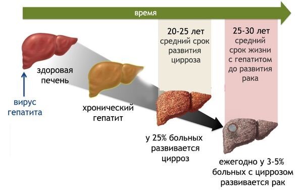 Стоимость лечения вирусного гепатита С