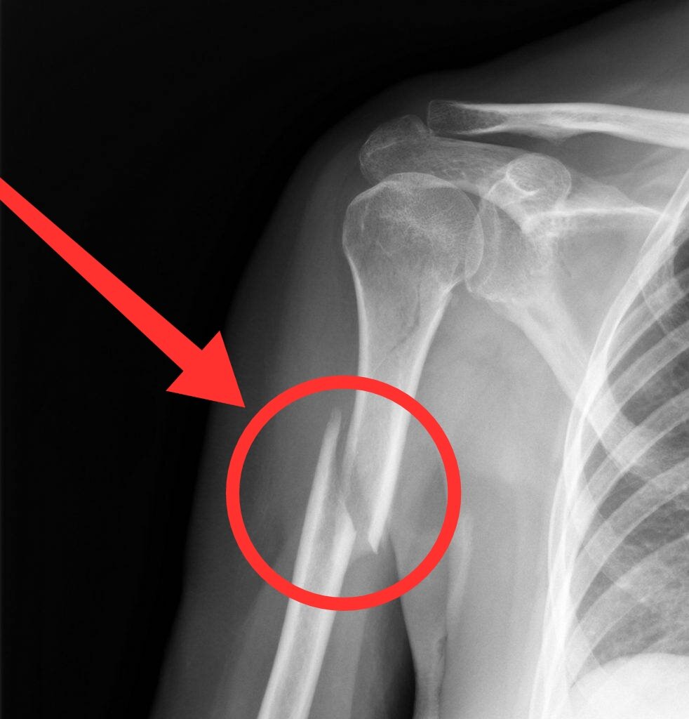 Операция после перелома плеча. Оскольчатый перелом плечевой кости. Перелом плечевой кости рентген. Диафизарный перелом плечевой кости. Перелом средней трети диафиза плечевой кости.