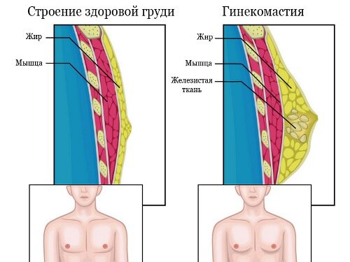 Гинекомастия: причины, симптомы и лечение