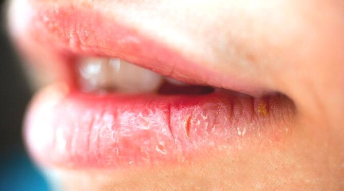 О каких болезнях могут сигнализировать сухие губы