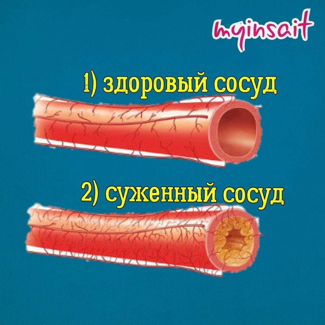 Рисунки здорового и суженного сосудов 
