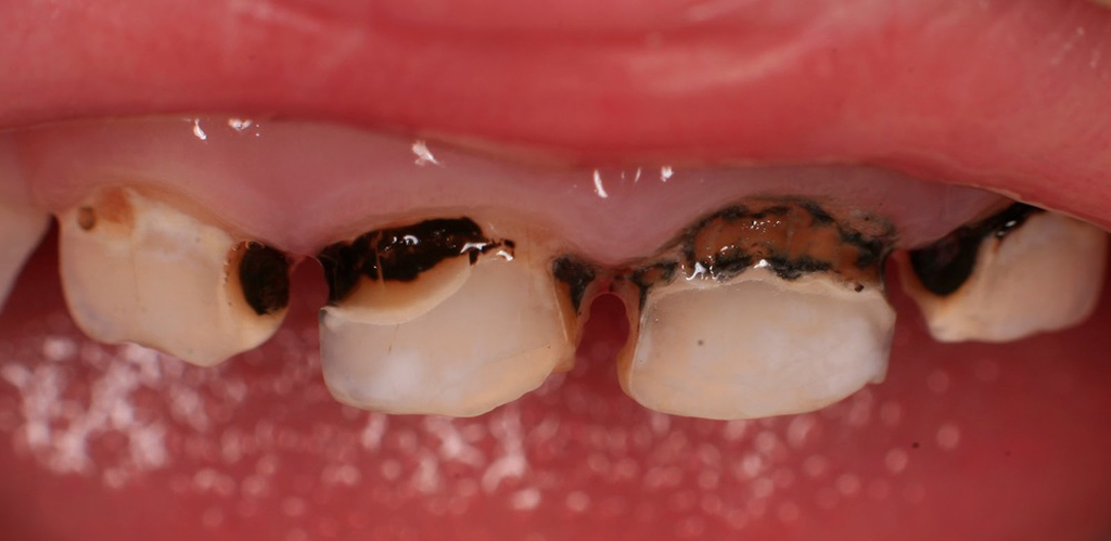 Заболевание кариесом молочных зубов. Фото: dentconsult.ru