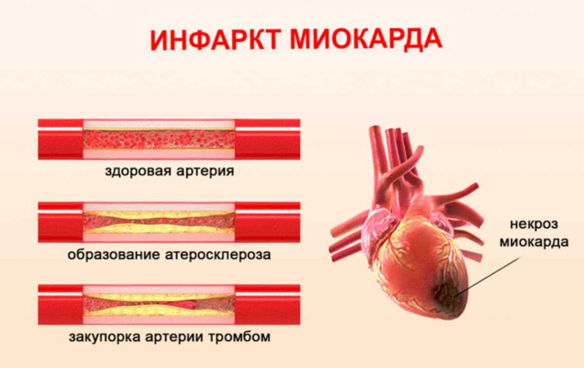 Инфаркт что это такое. Развитие инфаркта миокарда. Инфаркт миокарда картинки.