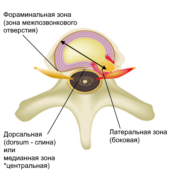 Фораминальная грыжа